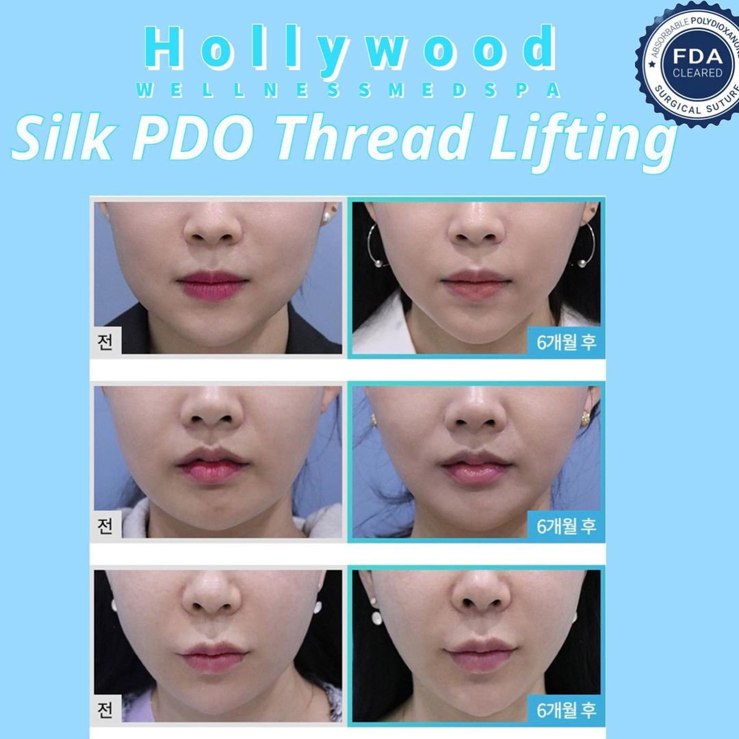 Silk PDO Thread Lifing