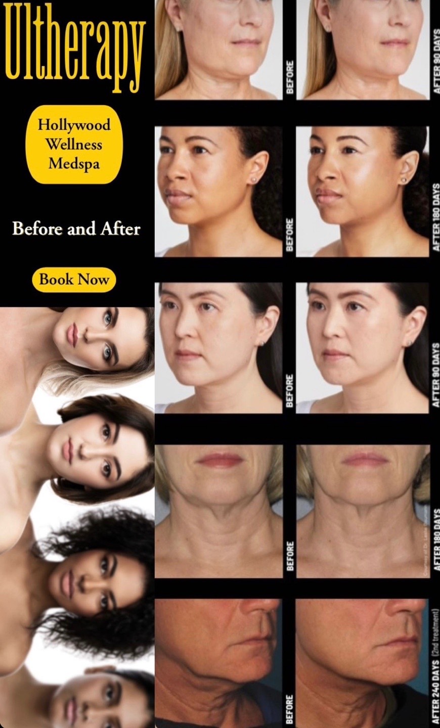 Ultherapy before and after!